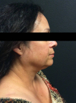 Ultherapy Case 4 Before